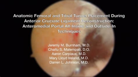 Anatomic Femoral And Tbial Tunnel Placement In Acl Reconstruction Youtube