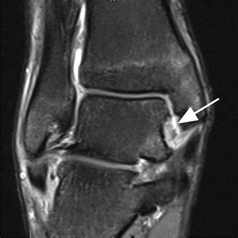 Medial Ankle Ligaments Mri