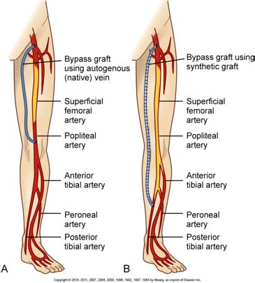 Peripheral Vascular Disease Flashcards Quizlet