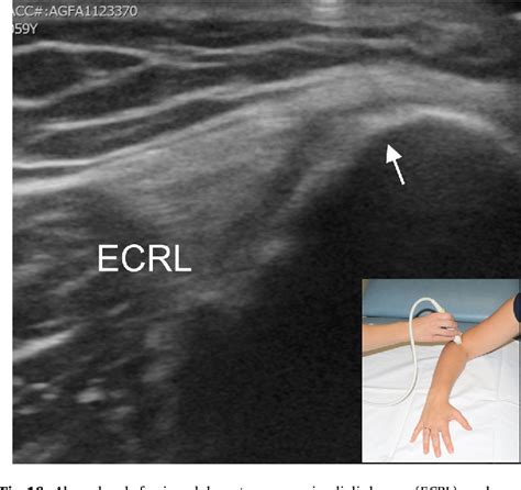 Figure 16 From Ultrasound Of The Elbow With Emphasis On Detailed