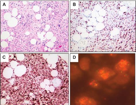 Dedifferentiated Liposarcoma A Lipomatous And Non Lipomatous Areas