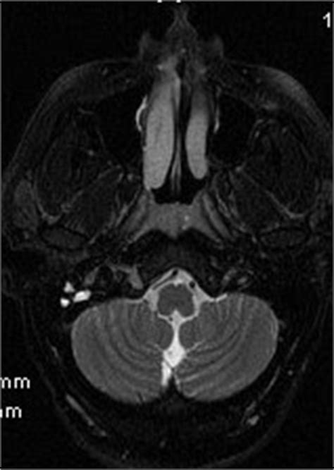 Glomus Tympaniucm-MRI &CT - Sumer's Radiology Blog