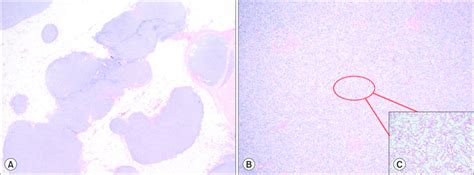 Low Power A Histologic Examination Revealed A Cystic Lesion And