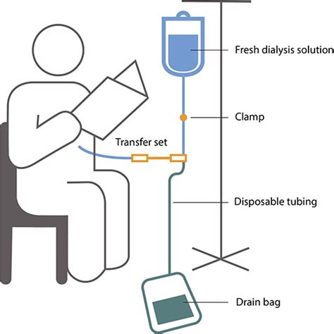 Peritoneal Dialysis - NIDDK