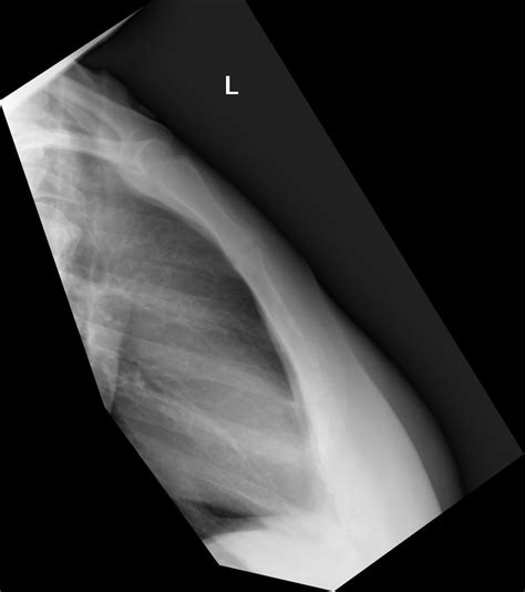 Normal lateral sternum | Radiology Case | Radiopaedia.org | Radiology ...