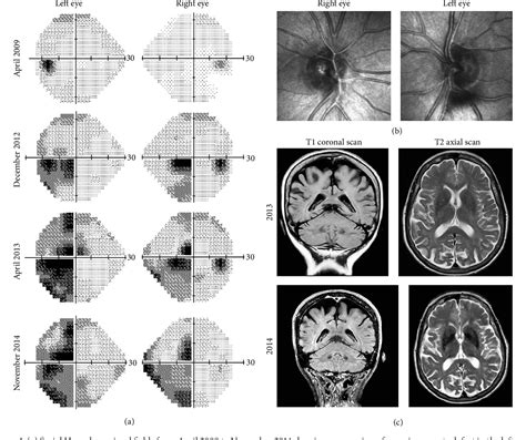 Figure 1 From Posterior Cortical Atrophy Presenting With Superior