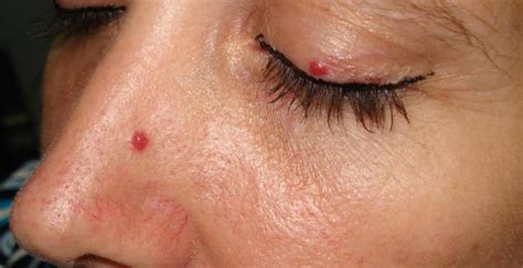 Cherry Angioma | Current Health Advice, Health Blog Articles and Tips