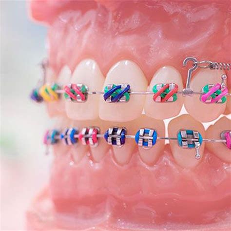 Cuántos tipos de brackets hay y cuáles son más efectivos Clínica