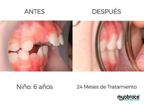 Tratamientos Miofuncionales Clinica De Ortodoncia