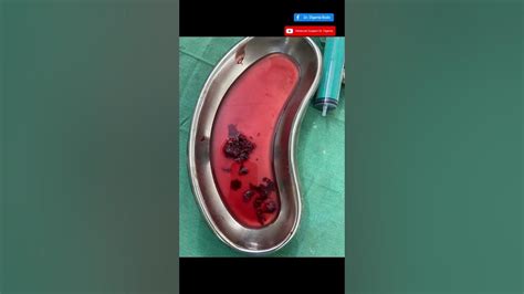 Rupture Ectopic Pregnancy Laparoscopic Excision Minimal Access