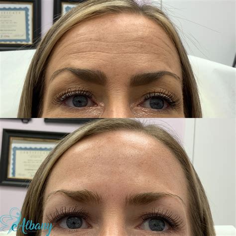 Botox For Forehead Lines Case No 1378 Albany Cosmetic And Laser