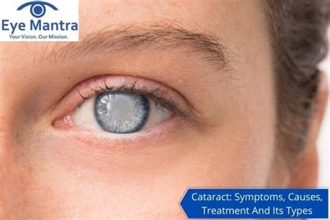 What Is A Cataract Surgery Causes Treatments Signs Of Cataracts