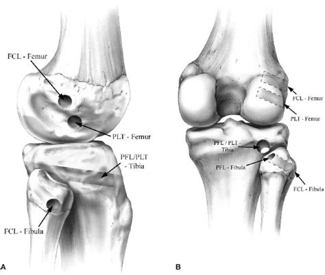 The Femoral Tibial And Fibular Posterolateral Knee Reconstruction