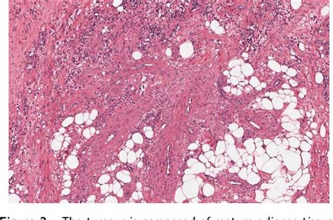 Figure From Angiomyolipoma Of The Palate Displaying Growth Potential