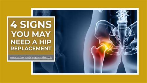 4 Signs You May Need A Hip Replacement Mr David Stitson Consultant Orthopaedic Surgeon