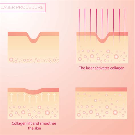 Skin Issues Pico Laser Skin Rejuvenation Can Treat