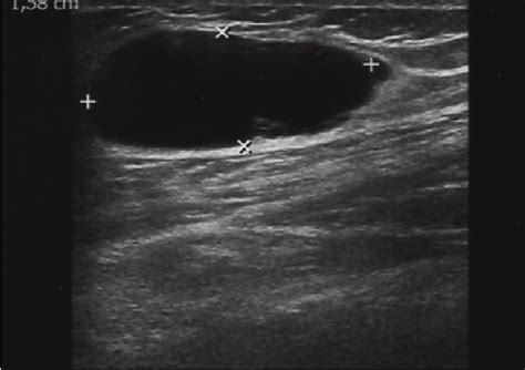 Ganglion Cyst Wrist Ultrasound