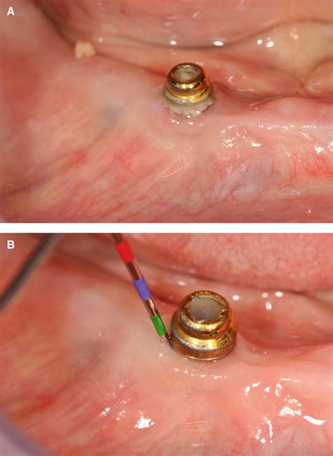 A Typical Example Of Biofilm Accumulation Around An Implant In A