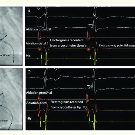 Monitoring Of Diaphragmatic CMAP With Phrenic Nerve Pacing Through