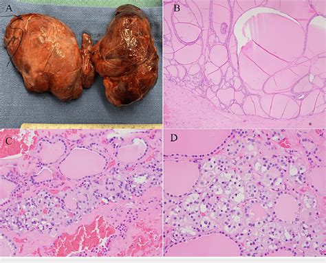 Gross And Microscopic Findings From Total Thyroidectomy Specimen A