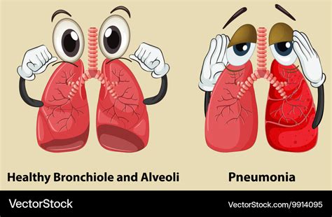 Diagram showing healthy and pneumonia lungs Vector Image