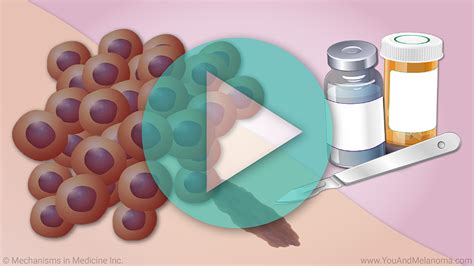 Animation - Diagnosing Melanoma