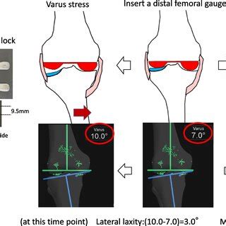 Pdf Short Term Clinical Results Of Bicruciate Retaining Total Knee