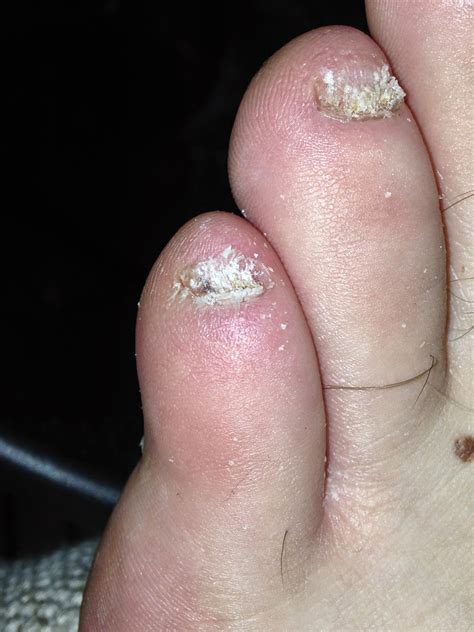 My Journey With Vicks Vaporub For Toenail Fungus Day 41 Of Vicks