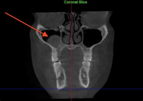 What Is A Mucous Retention Cyst Of The Maxillary Sinus - Infoupdate.org