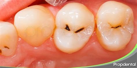 ¿cuáles Son Las Causas De La Caries Dental En Los Dientes