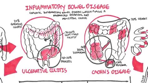 Inflammatory Bowel Disease Crohns And Ulcerative Colitits Youtube