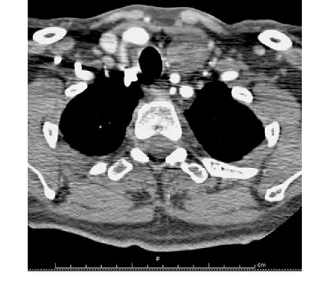 Computed Tomography Contrast Enhanced Scan Showing A Round Mass With