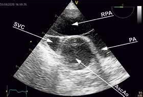 Mid Oesophageal Ascending Aorta Short Axis View Sax Anatomic