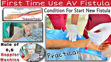 New Av Fistula Start First Time Use Of Av Fistula Doppler Of Av