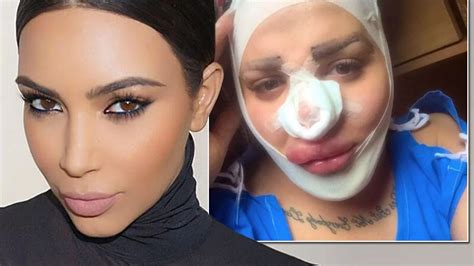 Male Kim Kardashian Wannabe Has Second Nose Job And Chin Implant But