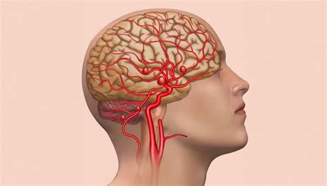 Anevrismul Cerebral Cauze Simptome Tratament I Recuperare Neuroaxis