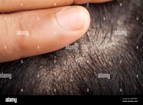 Close Up View Of Scalp Of A Man With Dandruff Suffering From Seborrheic