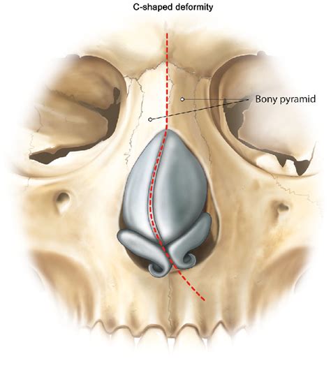 Nasal Septum Bones