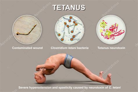 Mechanism of tetanus disease, 3D illustration. A skin wound is ...