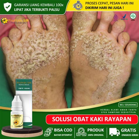 Obat Oles Kaki Rayapan Obat Kaki Rayapan Pitted Kertolysis Kaki Bau