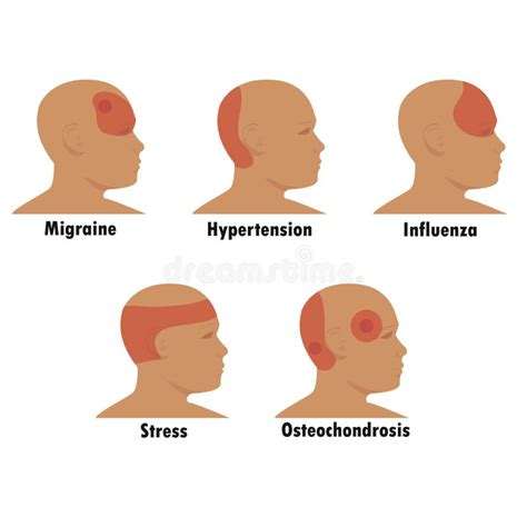 Types De Maux De T Te Tension Sinus En Grappe Et Stress Hypertension