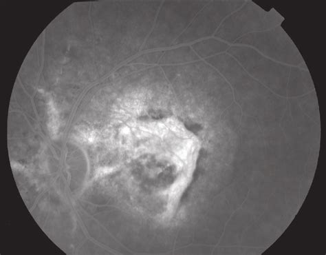 Fluorescein Angiography Of Right Eye With Angioid Streaks Complicated Download Scientific