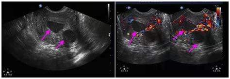 Transvaginal Ultrasound Scan Of The Uterus Indicating The Lesion With