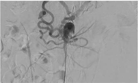 Angiography showing a decreased flow from celiac trunk. | Download ...