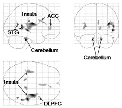 A Statistical Parametric Map In Glass Brain Format Of Regions