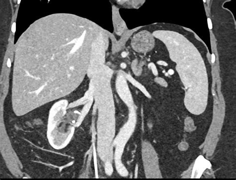 Fibromuscular Dysplasia Fmd Right Renal Artery With Stent In Right