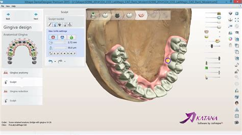 How To Design An Artificial Gingiva For Hybrid Implants Bridge In