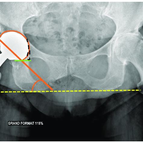 Acetabular Centers Of Rotation Pelvic Anteroposterior Radiograph The