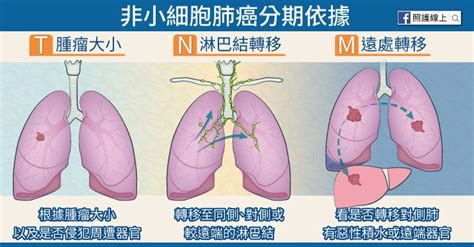 多年居國人癌症死亡率第一名，肺癌第三期怎麼辦？醫師圖文解說｜肺癌｜癌症｜元氣網