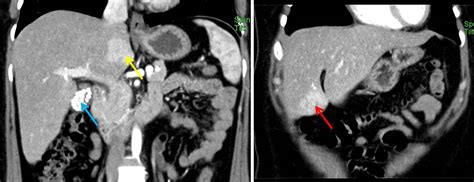 Focal Nodular Hyperplasia Of Liver Radiology Cases